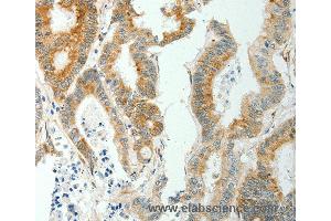 Immunohistochemistry of Human thyroid cancer using SELM Polyclonal Antibody at dilution of 1:50 (SELM anticorps)
