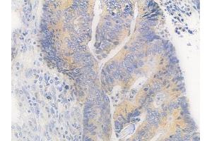 ABIN6260388 and ABIN6279218 at 1/100 staining human colon carcinoma by IHC-P. (CABP1 anticorps  (Internal Region))