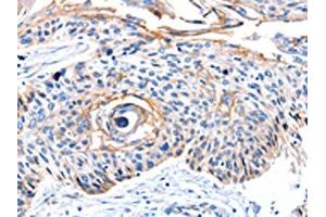 The image on the left is immunohistochemistry of paraffin-embedded Human esophagus cancer tissue using ABIN7190097(CCNB2 Antibody) at dilution 1/10, on the right is treated with synthetic peptide.