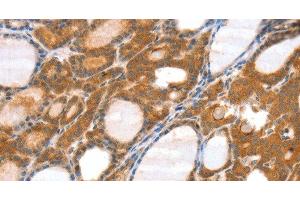 Immunohistochemistry of paraffin-embedded Human thyroid cancer tissue using SRGAP3 Polyclonal Antibody at dilution 1:40 (SRGAP3 anticorps)