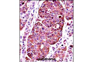 TYR Antibody (Center) ((ABIN391521 and ABIN2841481))immunohistochemistry analysis in formalin fixed and paraffin embedded human melanoma followed by peroxidase conjugation of the secondary antibody and DAB staining.