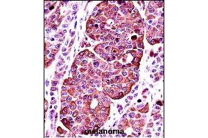 TYR Antibody (Center) ((ABIN391521 and ABIN2841481))immunohistochemistry analysis in formalin fixed and paraffin embedded human melanoma followed by peroxidase conjugation of the secondary antibody and DAB staining. (TYR anticorps  (AA 176-205))