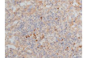 ABIN6268776 at 1/50 staining human breast cancer tissue sections by IHC-P.