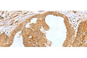 Immunohistochemistry of paraffin-embedded Human thyroid cancer tissue using MRPS28 Polyclonal Antibody at dilution of 1:60(x200)