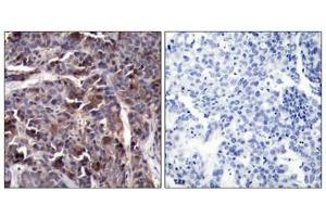 Immunohistochemical analysis of paraffin-embedded human breast carcinoma tissue using NFkB-p65(Phospho-Thr505) Antibody(left) or the same antibody preincubated with blocking peptide(right).