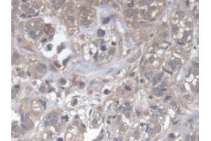DAB staining on IHC-P; Samples: Human Breast cancer Tissue (DOCK4 anticorps  (AA 1-300))