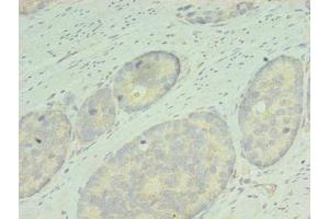 Immunohistochemistry of paraffin-embedded human gastric cancer using ABIN7167836 at dilution of 1:100