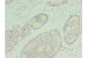 Immunohistochemistry of paraffin-embedded human gastric cancer using ABIN7167836 at dilution of 1:100 (RDH12 anticorps  (AA 1-316))