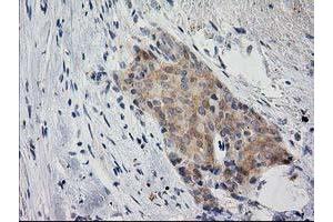 Immunohistochemical staining of paraffin-embedded Adenocarcinoma of Human breast tissue using anti-EIF4E2 mouse monoclonal antibody. (EIF4E2 anticorps)