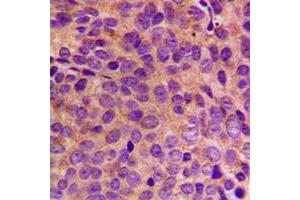 Immunohistochemical analysis of Cytokeratin 18 staining in human breast cancer formalin fixed paraffin embedded tissue section. (Cytokeratin 18 anticorps  (C-Term))