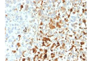 Formalin-fixed, paraffin-embedded human Melanoma stained with Vimentin Rabbit Recombinant Monoclonal Antibody (VIM/1937R).