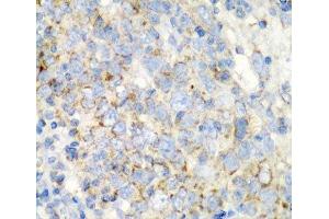 Immunohistochemistry of paraffin-embedded Human esophageal cancer using PRKCQ Polyclonal Antibody at dilution of 1:200 (40x lens). (PKC theta anticorps)
