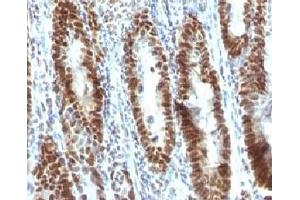 Formalin-fixed, paraffin-embedded human gastric carcinoma stained with TOX3 antibody (TOX3/1123).