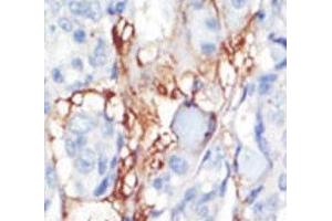 IHC analysis of FFPE human breast carcinoma tissue stained with the PDGFRL antibody (PDGFRL anticorps  (AA 328-357))