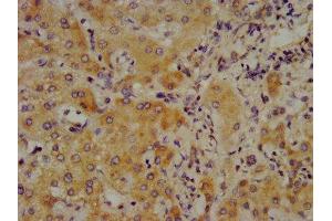 IHC image of ABIN7148361 diluted at 1:700 and staining in paraffin-embedded human liver cancer performed on a Leica BondTM system.