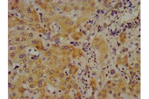 IHC image of ABIN7148361 diluted at 1:700 and staining in paraffin-embedded human liver cancer performed on a Leica BondTM system. (C4A anticorps  (AA 1027-1186))