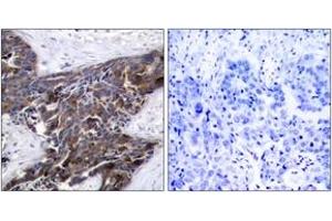 Immunohistochemistry analysis of paraffin-embedded human breast carcinoma, using Connexin 43 (Phospho-Ser367) Antibody.