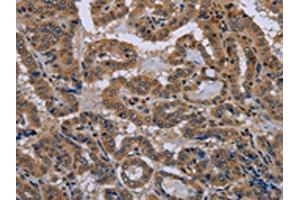 The image on the left is immunohistochemistry of paraffin-embedded Human thyroid cancer tissue using (NPHS2 Antibody) at dilution 1/40, on the right is treated with synthetic peptide. (Podocin anticorps)