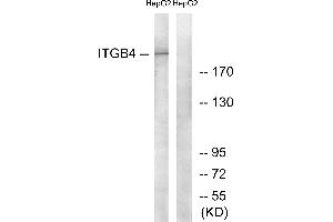 Immunohistochemistry analysis of paraffin-embedded human breast carcinoma tissue using ITGB4 (Ab-1510) antibody. (Integrin beta 4 anticorps)