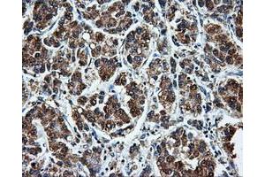 Immunohistochemical staining of paraffin-embedded Carcinoma of liver tissue using anti-LEMD3mouse monoclonal antibody. (LEMD3 anticorps)