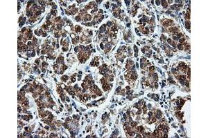 Immunohistochemical staining of paraffin-embedded Carcinoma of liver tissue using anti-LEMD3mouse monoclonal antibody.