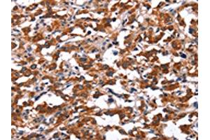 The image on the left is immunohistochemistry of paraffin-embedded Human thyroid cancer tissue using ABIN7191188(KCNJ9 Antibody) at dilution 1/15, on the right is treated with synthetic peptide. (KCNJ9 anticorps)
