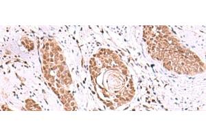 Immunohistochemistry of paraffin-embedded Human esophagus cancer tissue using RUVBL1 Polyclonal Antibody at dilution of 1:85(x200) (RUVBL1 anticorps)