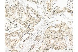 ABIN7094796 and ABIN7098847 at 1/100 staining Human breast cancer by IHC-P. (SF3B1 anticorps  (N-Term))
