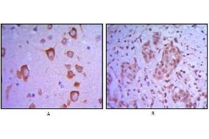 Immunohistochemical analysis of paraffin-embedded human brain tissue (A) and breast tumor (B) uing ETS1 antibody. (ETS1 anticorps)