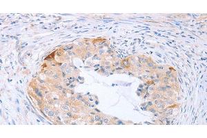Immunohistochemistry of paraffin-embedded Human cervical cancer tissue using CARD6 Polyclonal Antibody at dilution 1:60 (CARD6 anticorps)
