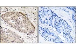 Immunohistochemistry analysis of paraffin-embedded human lung carcinoma tissue, using ALS2CR8 Antibody.