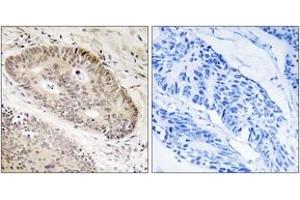 Immunohistochemistry analysis of paraffin-embedded human lung carcinoma tissue, using ALS2CR8 Antibody. (Calcium Responsive Transcription Factor (CARF) (AA 311-360) anticorps)