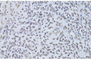 Immunohistochemistry of paraffin-embedded Human adenomyosis using LMNB2 Polyclonal Antibody at dilution of 1:100 (40x lens).