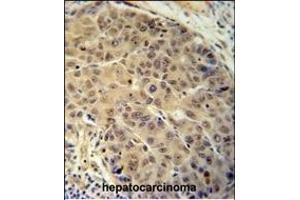 BUD13 antibody (C-term) (ABIN654718 and ABIN2844407) immunohistochemistry analysis in formalin fixed and paraffin embedded human hepatocarcinoma followed by peroxidase conjugation of the secondary antibody and DAB staining. (BUD13 anticorps  (C-Term))