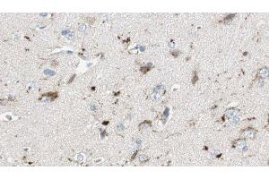 ABIN6275683 at 1/100 staining Human brain cancer tissue by IHC-P. (WASF3 anticorps  (Internal Region))
