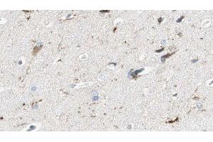 ABIN6275447 at 1/100 staining Human brain cancer tissue by IHC-P.