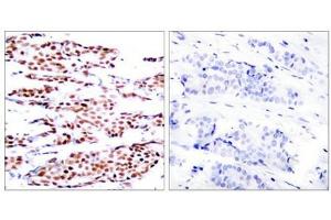Immunohistochemical analysis of paraffin-embedded human breast carcinoma tissue using JunB(Phospho-Ser79) Antibody(left) or the same antibody preincubated with blocking peptide(right). (JunB anticorps  (pSer79))