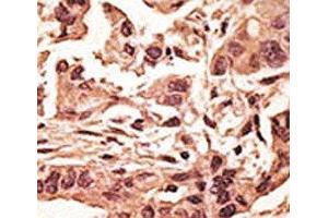 IHC analysis of FFPE human breast carcinoma tissue stained with the SIRT6 antibody