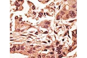 IHC analysis of FFPE human breast carcinoma tissue stained with the SIRT6 antibody (SIRT6 anticorps  (AA 290-319))