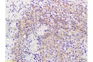 Formalin-fixed and paraffin embedded mouse lymphoma labeled with Rabbit Anti MAP3K8/TPL2 Polyclonal Antibody, Unconjugated (ABIN701275) at 1:200 followed by conjugation to the secondary antibody and DAB staining