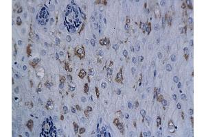 Formalin-fixed and paraffin embedded human esophageal cancer labeled with Anti-XRCC1 Polyclonal Antibody, Unconjugated (ABIN673539) followed by conjugation to the secondary antibody and DAB staining