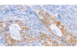 Immunohistochemistry of paraffin-embedded Human cervical cancer tissue using DOK4 Polyclonal Antibody at dilution 1:50 (DOK4 anticorps)