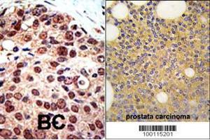 Formalin-fixed and paraffin-embedded human prostata carcinoma tissue reacted with PRMT3 Antibody , which was peroxidase-conjugated to the secondary antibody, followed by DAB staining. (PRMT3 anticorps  (C-Term))