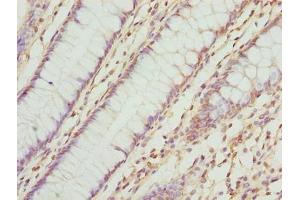 Immunohistochemistry of paraffin-embedded human colon cancer using ABIN7173063 at dilution of 1:100 (TMEM143 anticorps  (AA 8-278))