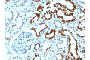 Formalin-fixed, paraffin-embedded human Renal Cell Carcinoma stained with Milk Fat Globule Monoclonal Antibody (MFG-06)