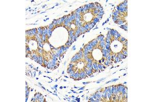 Immunohistochemistry of paraffin-embedded human colon carcinoma using VD antibody (ABIN7271335) at dilution of 1:100 (40x lens). (VDAC1 anticorps)