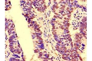 Immunohistochemistry of paraffin-embedded human colon cancer using ABIN7161302 at dilution of 1:100 (NOTCH3 anticorps  (AA 1301-1496))