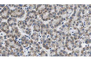 ABIN6268770 at 1/100 staining Human liver cancer tissue by IHC-P. (AQP3 anticorps  (Internal Region))