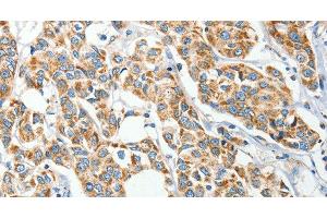 Immunohistochemistry of paraffin-embedded Human breast cancer tissue using IFT74 Polyclonal Antibody at dilution 1:60 (IFT74 anticorps)