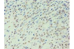 Immunohistochemistry of paraffin-embedded human breast cancer using ABIN7141988 at dilution of 1:100 (BCKDK anticorps  (AA 153-412))